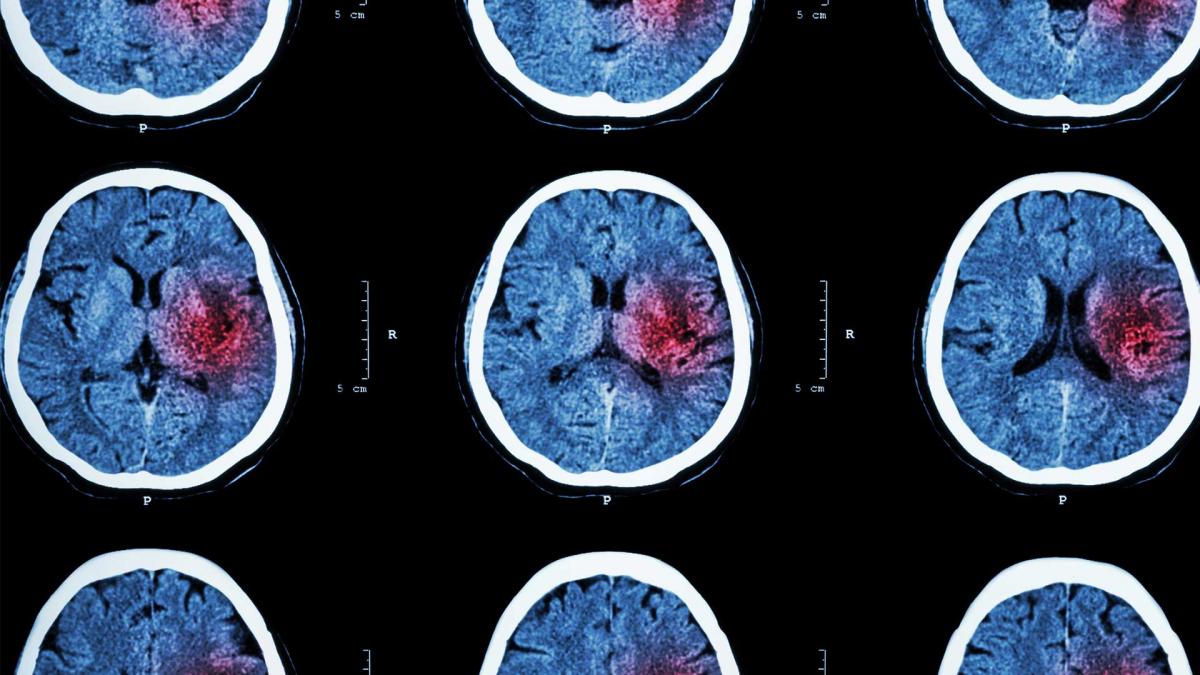 MRI scan